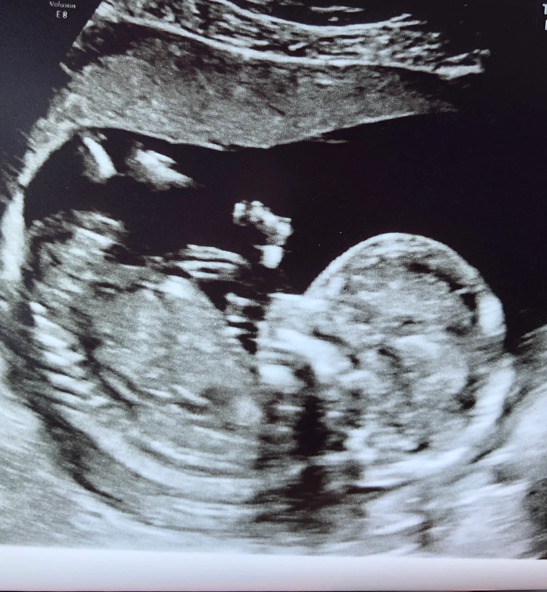 baby ultrascan